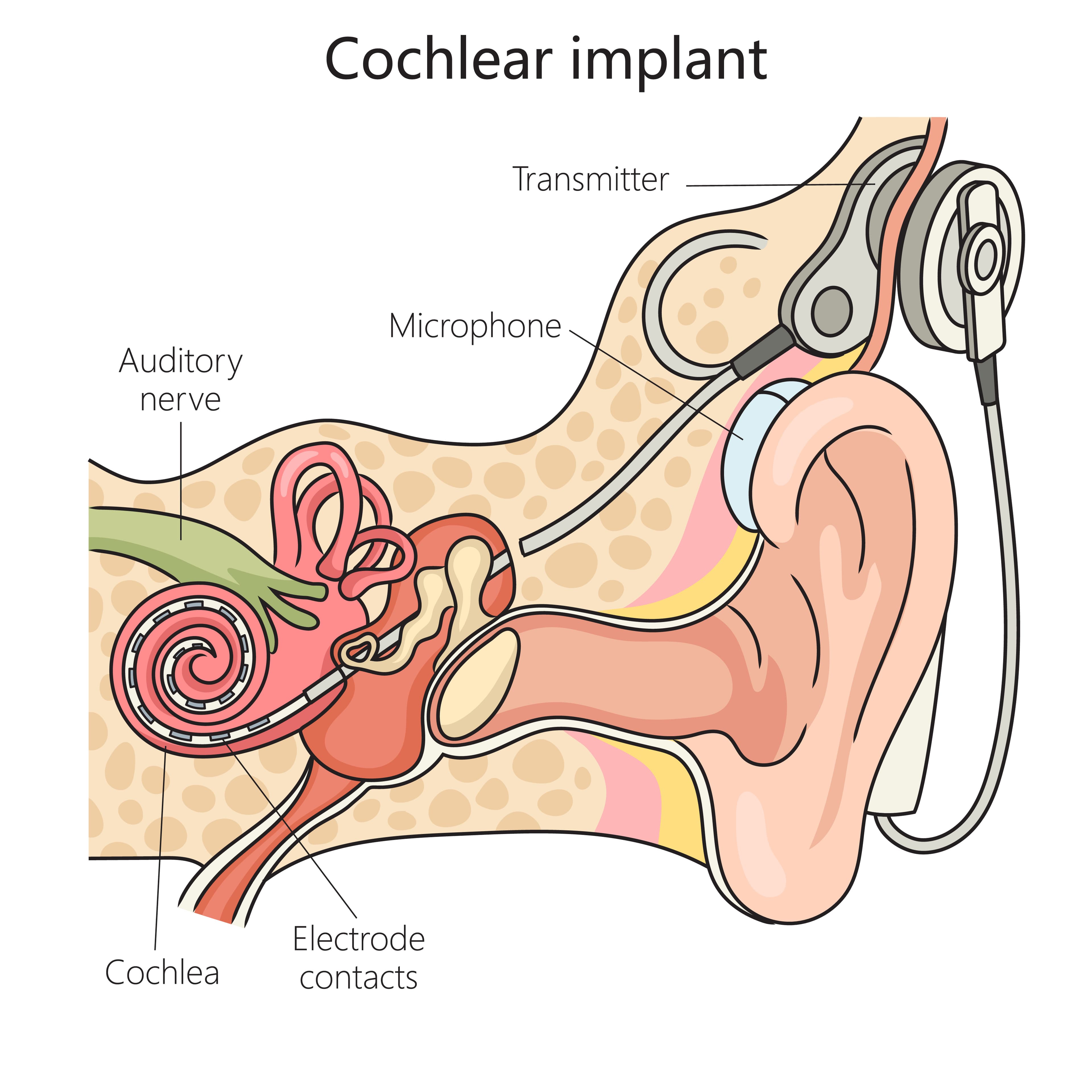 Diagram showing how cochlear implants work
